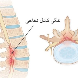 کانال تلگرام تنگی کانال نخاعی